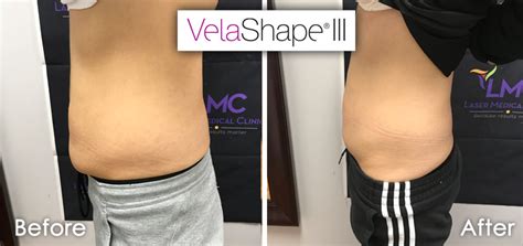 velashape columbus